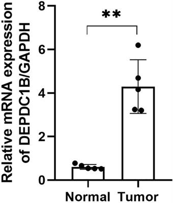 Identification and Validation of DEPDC1B as an Independent Early Diagnostic and Prognostic Biomarker in Liver Hepatocellular Carcinoma